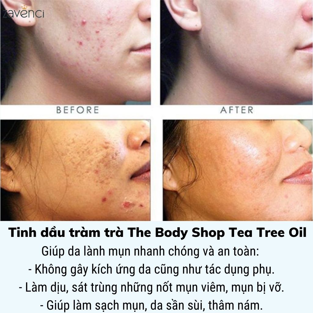 Tinh dầu tràm trà THE BODY SHOP Tea Tree Oil Làm Xẹp Mụn Giảm Viêm Hiệu Quả Sau 1 Đêm (10ml)