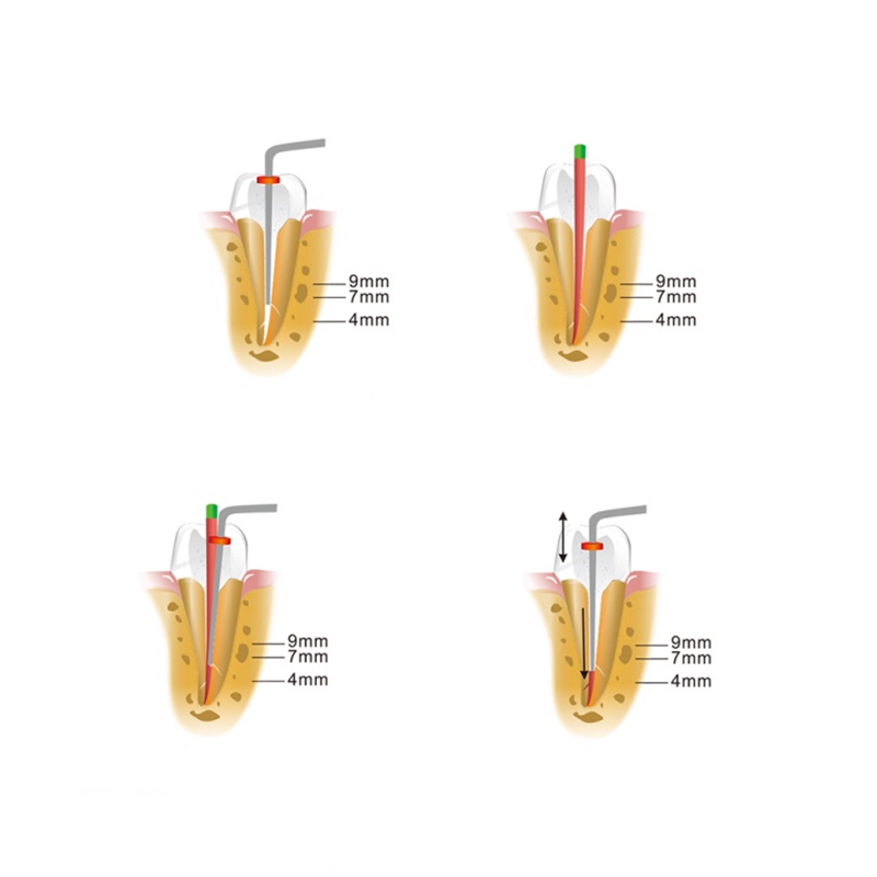 Bút Keo Nóng Chảy Mực Nha Khoa Kèm 2 Kim Sưởi Ấm