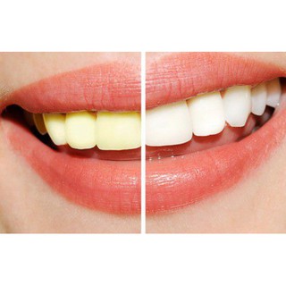 Gel tẩy trắng răng Opalescence