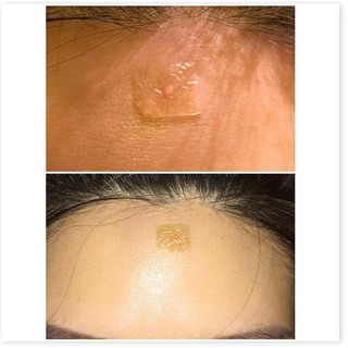 [Mã giảm giá mỹ phẩm chính hãng] Miếng Dán Mụn Duoderm Extra (1 miếng)