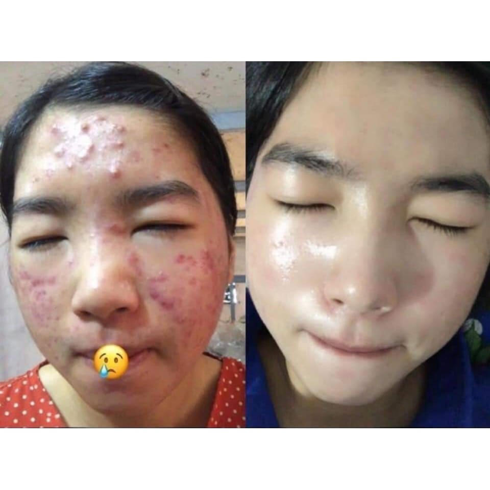 Serum Trị Mụn Cao Cấp Rulya Silk Anti Acnes | BigBuy360 - bigbuy360.vn