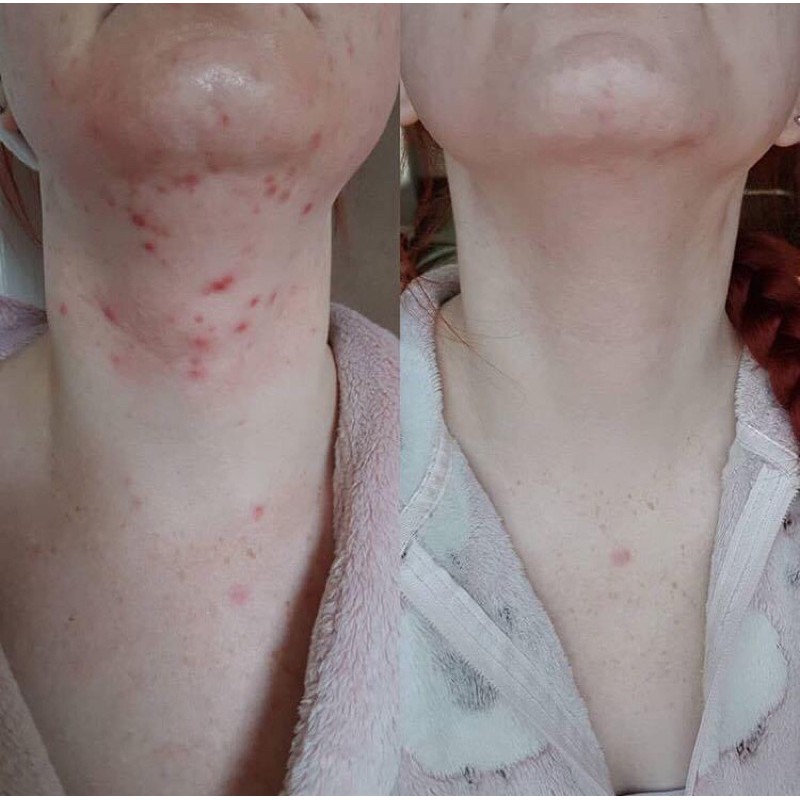 Kem hỗ trợ giảm mụn Azclear Action Lotion 25gr (Azelaic acid) | BigBuy360 - bigbuy360.vn