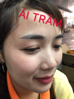 Chấm tàn nhang 7 ngày bong