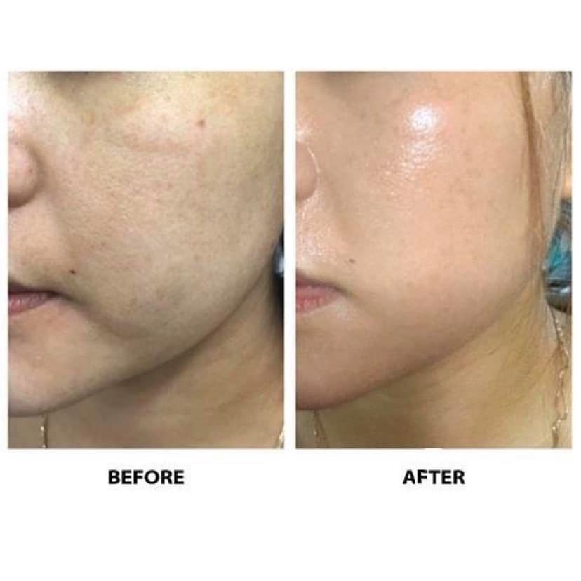 Serum mờ thâm sáng da giảm mụn Ekseption Hyaluronic Niacin 50ml