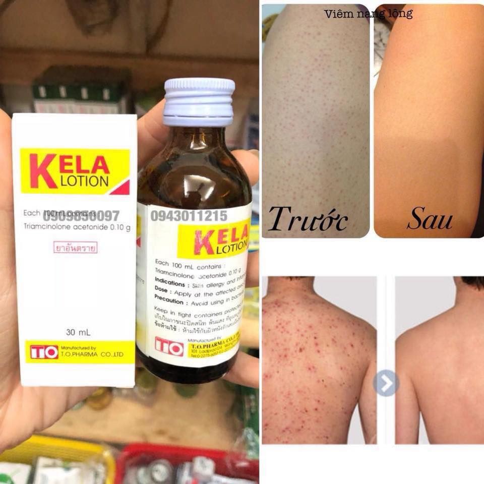 KELA LOTION Dành cho da Viêm Lỗ Chân Lông - Thái Lan