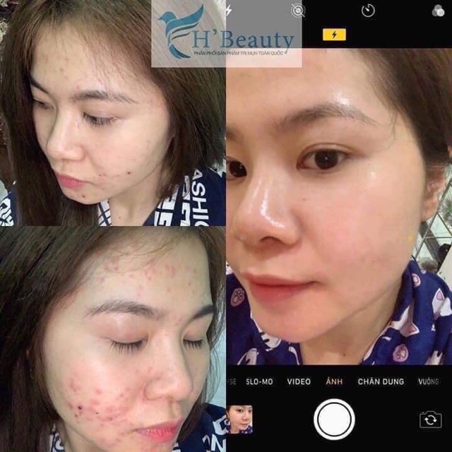 Kem Mụn X2 Th Beauty