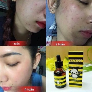 Serum Kosxu trị mụn _ Quynhloe92