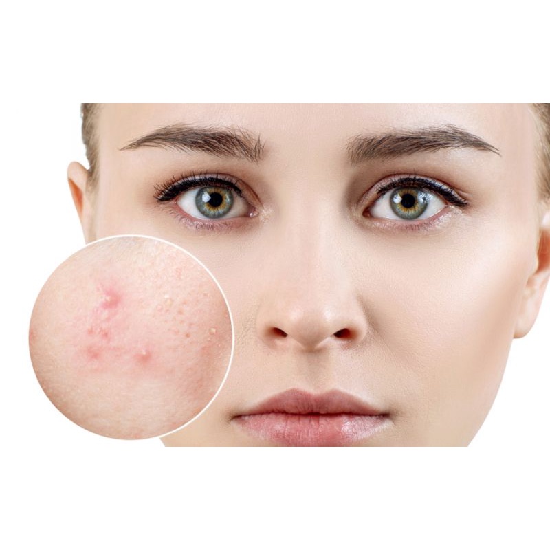 Dưỡng Da Mụn - CIAC CA GEL 10g | BigBuy360 - bigbuy360.vn