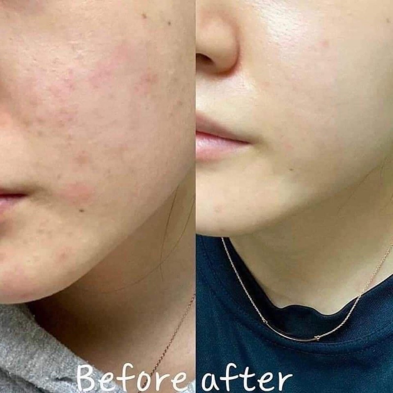 SERUM RAU MÁ CENTELLA SKIN 1004