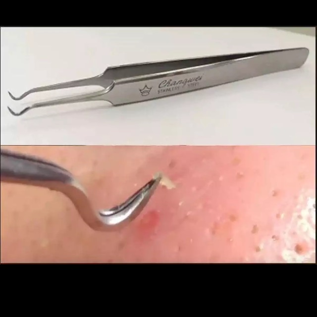 Nhiếp Gấp Mụn Cám