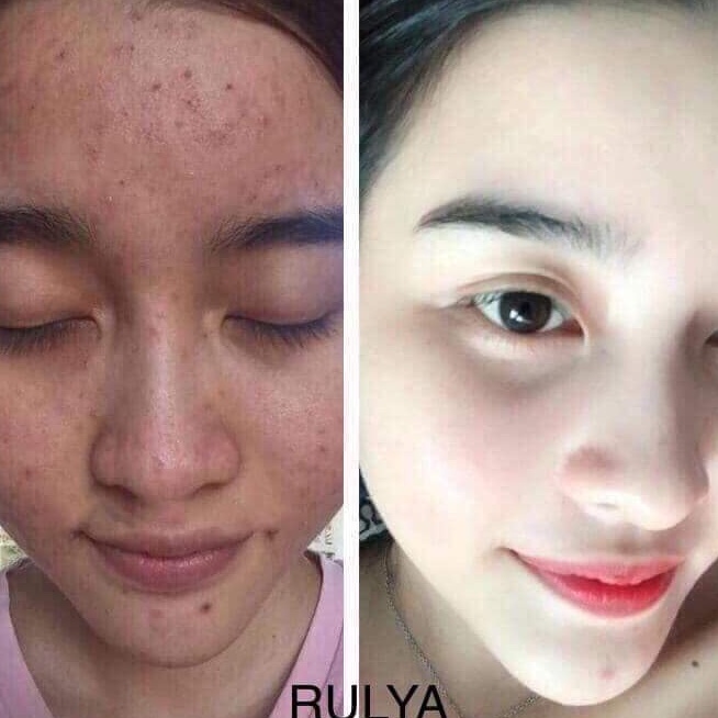 [ CHÍNH HÃNG] Serum Mụn Chính Hãng Rulya Anti Acne