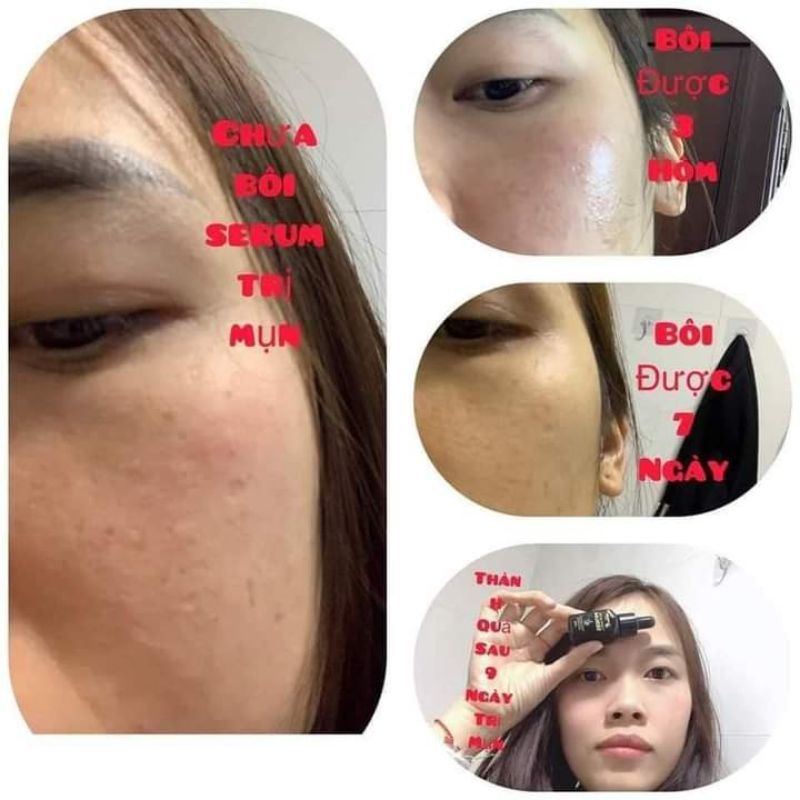Tinh chất serum hết mụn_Hết thâm sạm do sẹo_Se khít lỗ chân lông