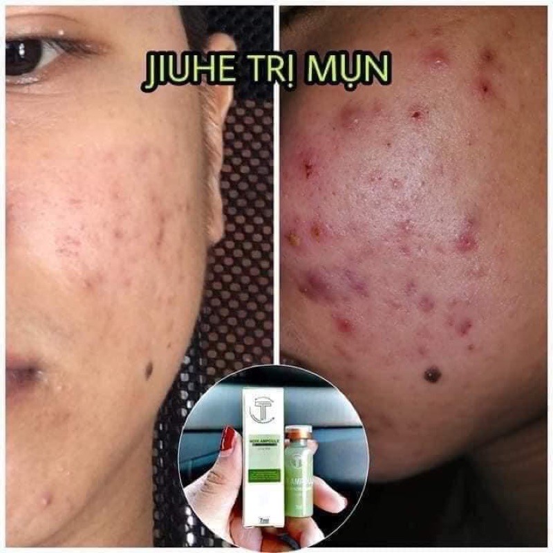 SERUM JIUHE ACNES NANO MỤN THANH TÔ CHÍNH HÃNG 100%