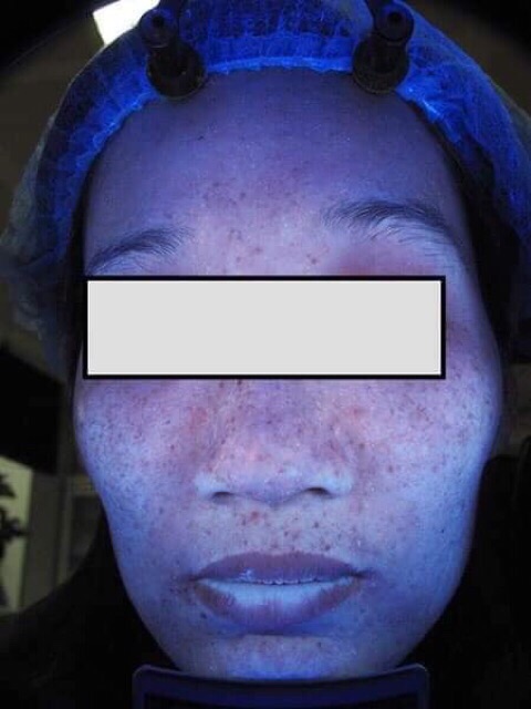 Đèn woodd soi danhd cho spa và thẩm mỹ viện chuyen nghiệp