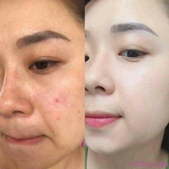 Serum gảm mụn cấp tốc TEANA SUPER PEPTIDES NO PROBLEM INTENSIVE, sản phẩm không thể thiếu trong quá trình đẩy mụn | BigBuy360 - bigbuy360.vn