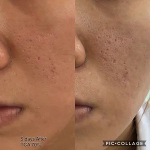 Peel chấm TCA 50%,75%, 80% Làm Đầy Sẹo Rỗ Sẹo Lõm Splendora | TRICHLOROACETIC ACID - Tặng kèm bao tay y tế