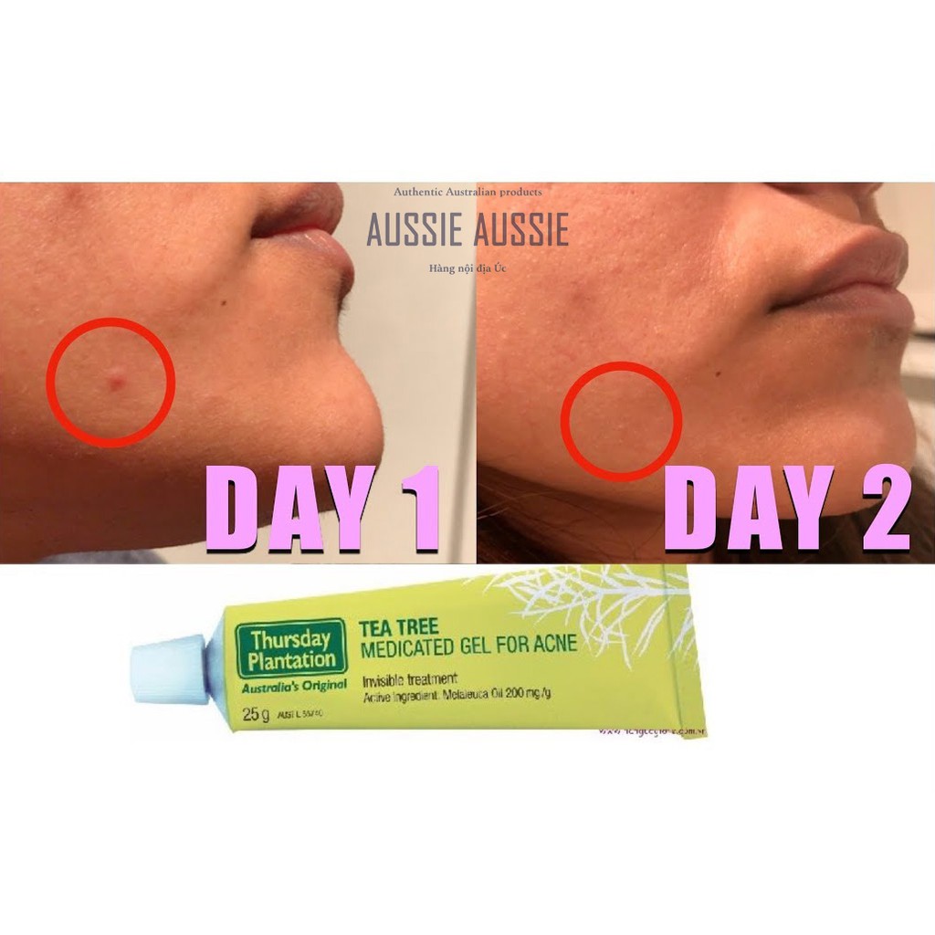 Gel chấm mụn tràm trà Úc Thursday Plantation Tea Tree Medicated Gel for Acne 25g aussie.vn | BigBuy360 - bigbuy360.vn