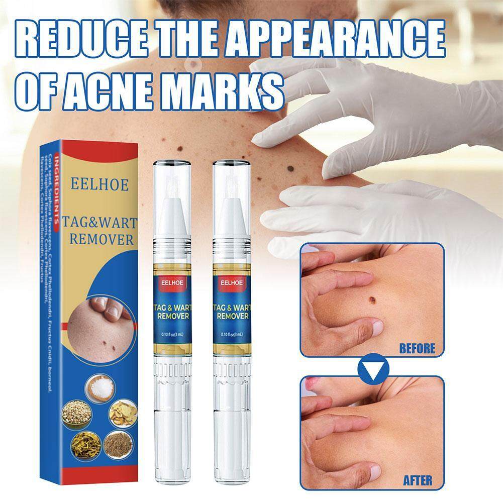 Skin Thẻ Bút Xóa Nốt Ruồi, Thẻ Da An Toàn Di Động, Nốt Ruồi Remover
