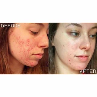 LOTION CHẤM MỤN BYE BYE BLEMISH