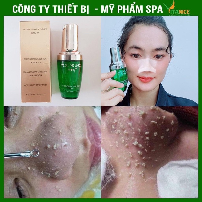 Ủ Mụn Youngerc 30ml - Đẩy tan mọi loại mụn - Siêu phẩm ủ mụn