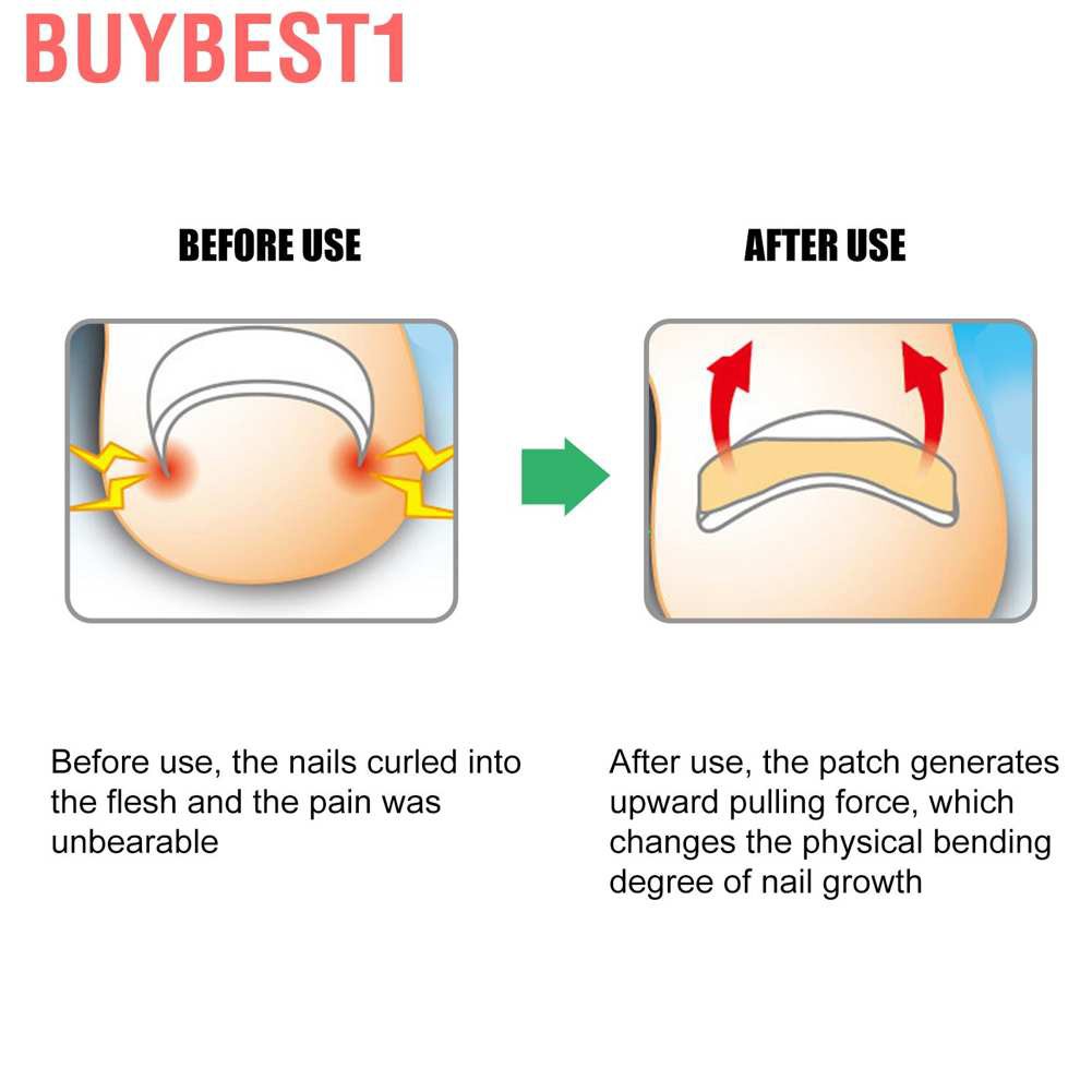 (Hàng Mới Về) Set 13 Miếng Dán Chỉnh Hình Móng Chân Tiện Dụng | BigBuy360 - bigbuy360.vn