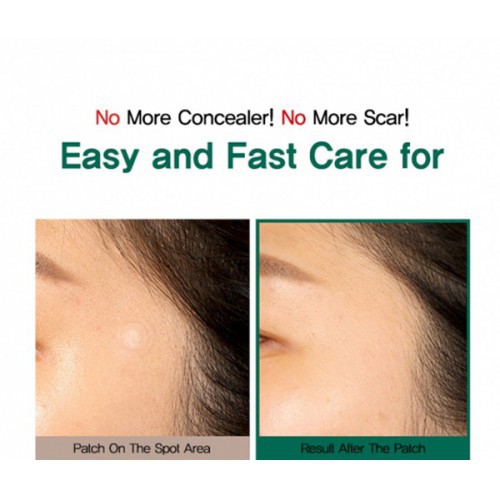 Miếng Dán Mụn Some By Mi / Miếng Dán Mụn Some By Me Clear Spot Patch