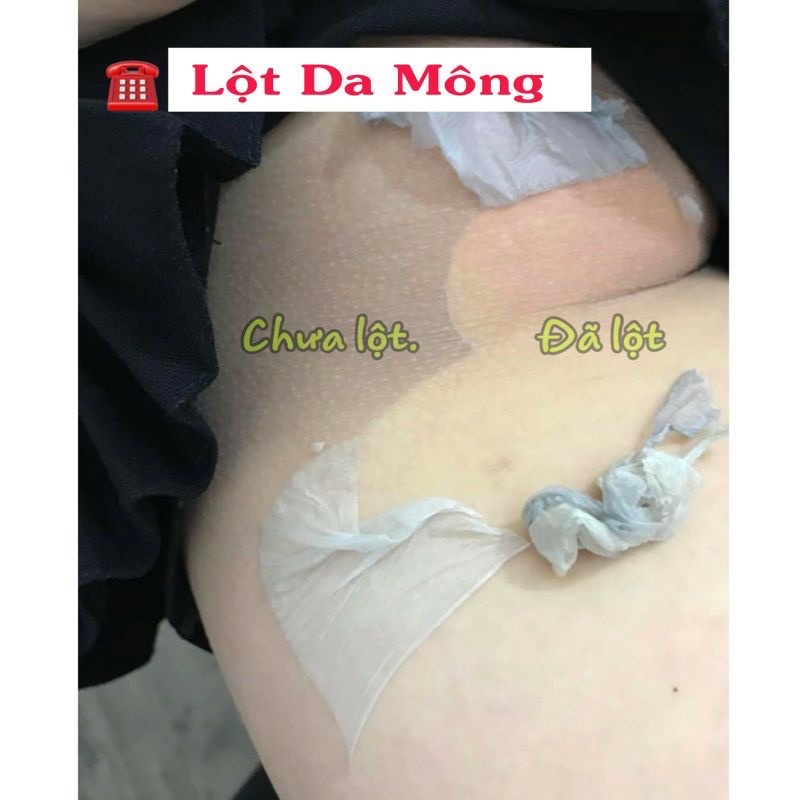 Thay Da Sinh Học Lột Mông Bụng Hết Thâm Rạn Da | BigBuy360 - bigbuy360.vn