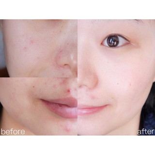 Chấm mụn bye bye blemish