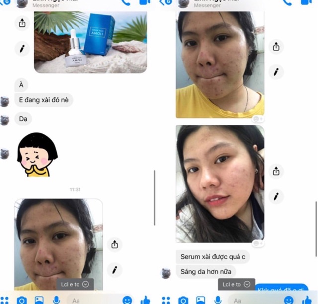 Serum Mụn Amoli | BigBuy360 - bigbuy360.vn