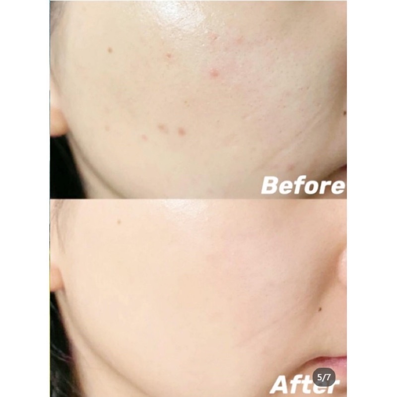 BHA Toner Pad tẩy tế bào da chết nhẹ nhàng cho da RNW / Ruwei