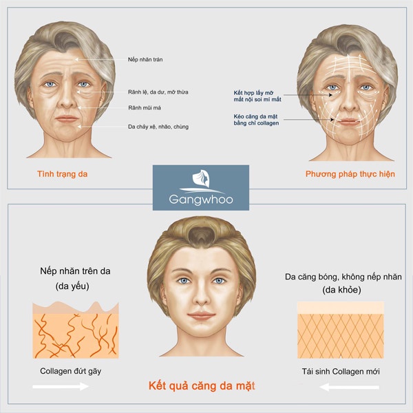 Căng da mặt bằng chỉ sinh học Collagen