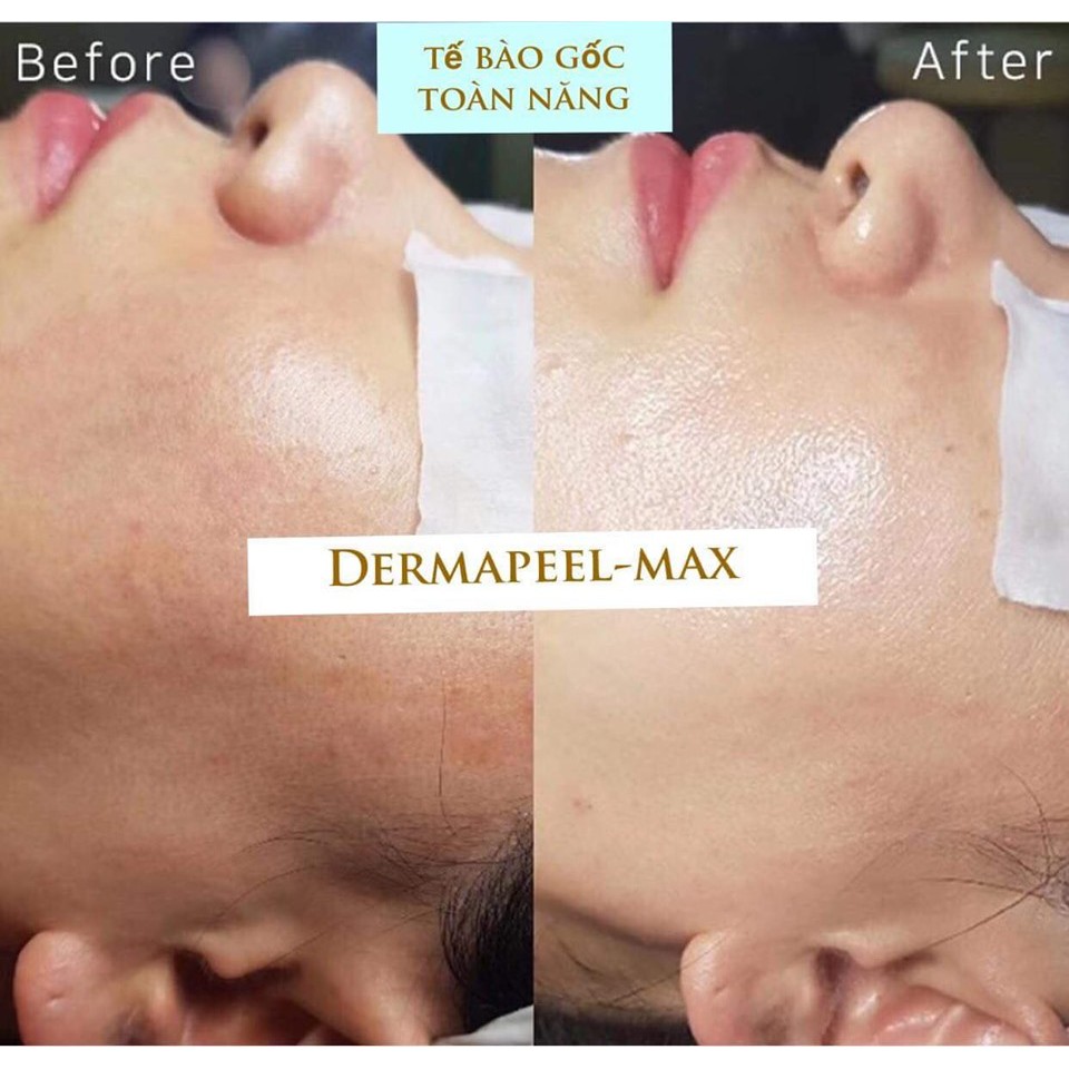 TẾ BÀO GỐC TOÀN NĂNG DERMAPEEL - MAX - DA CĂNG BÓNG - TRẮNG SÁNG - MỜ THÂM NÁM