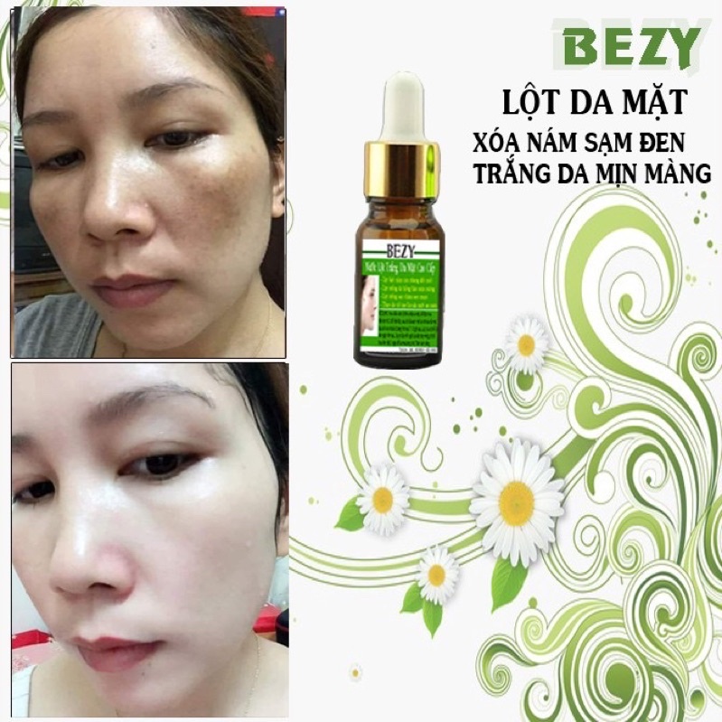 Tái Tạo Lột Thay Da Trắng Hết Nám Bezy