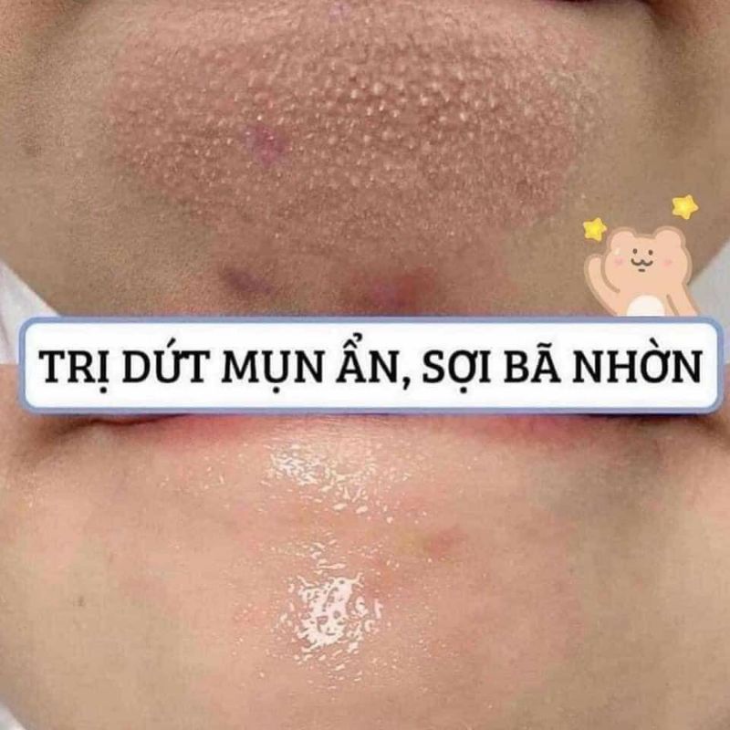 Klzit MS, C, Derma, Megaduo 15gr dạng gel giảm mụn, thâm tốt