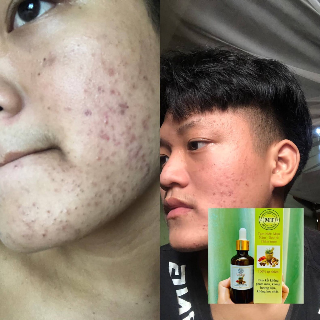 Thảo Dược Giảm Mụn Thâm Rỗ MT | BigBuy360 - bigbuy360.vn