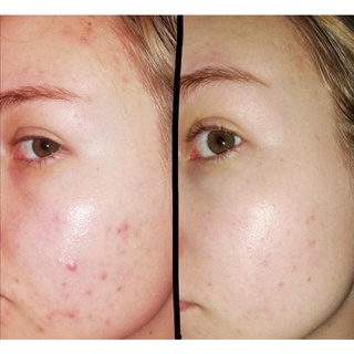 Kem dưỡng retinol A313