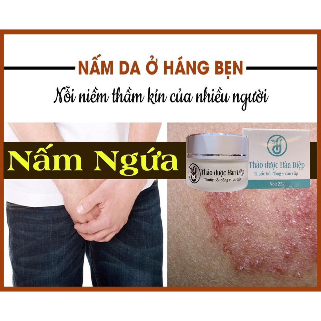 Kem bôi thảo mộc Hàn Diệp - Chuyên hắc lào, lang ben, tổ đỉa, vẩy nến, nấm chân tay, nứt nẻ, á sừng, nấm da...