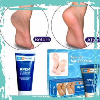 Kem trị nứt gót chân Kpem