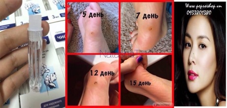 Chấm mụn thịt, mụn cóc, nốt ruồi Nga
