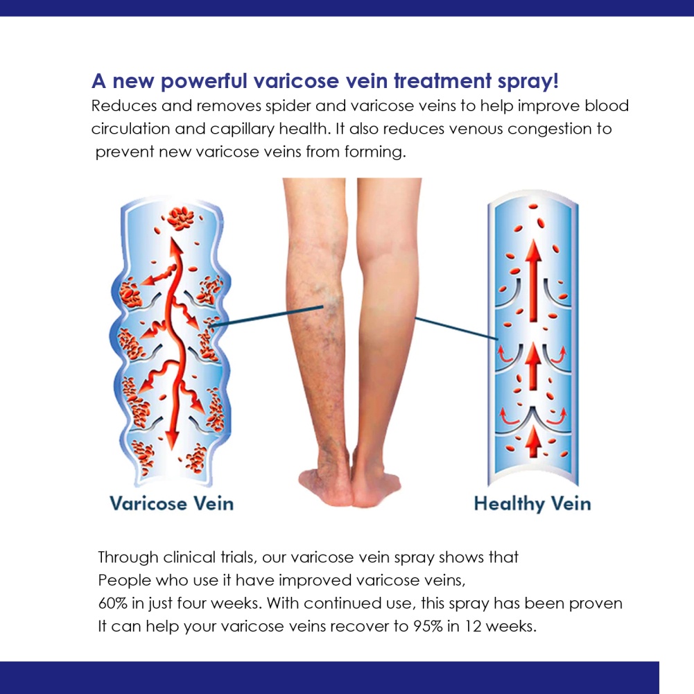 Chai Xịt Trị Giãn Tĩnh Mạch Cải Thiện Lưu Thông Máu Nhanh Chóng OUHOE