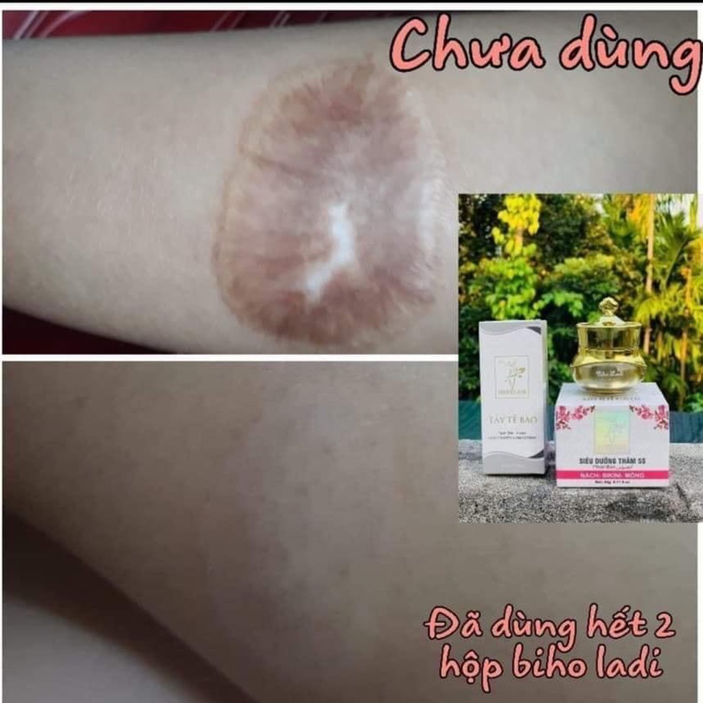 Siêu Dưỡng Thâm 5S BihoLadi Đánh Bay Thâm Nách, Thâm Mông, Bikini, Giúp Trắng Da, Mịn Da (Biho_Ladi, Biho_Lady) | BigBuy360 - bigbuy360.vn