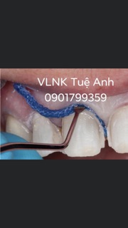 [CHÍNH HÃNG] CÂY ĐẶT CHỈ CO NƯỚU