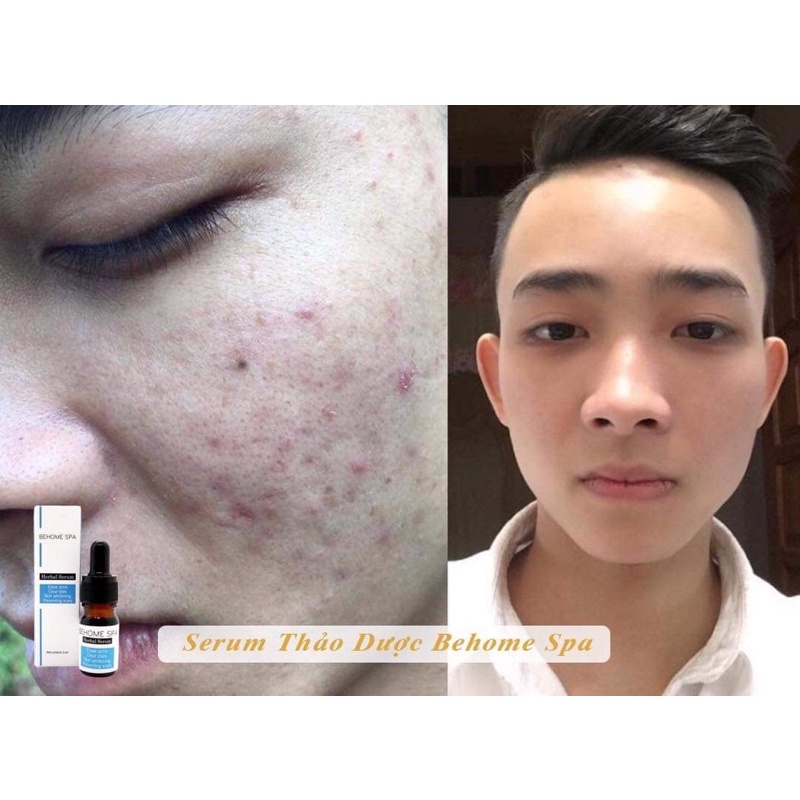 Serum mụn Thảo dược Behome Spa  👉FREESHIP👉 Serum mụn thảo Dược Behome Spa, Mụn ẩn, mụn thâm, mụn cám, mụn viêm | BigBuy360 - bigbuy360.vn