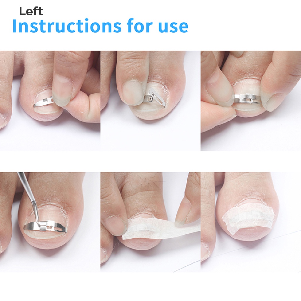 [Hàng mới về] 1 miếng dán chỉnh sửa móng chân mọc ngược