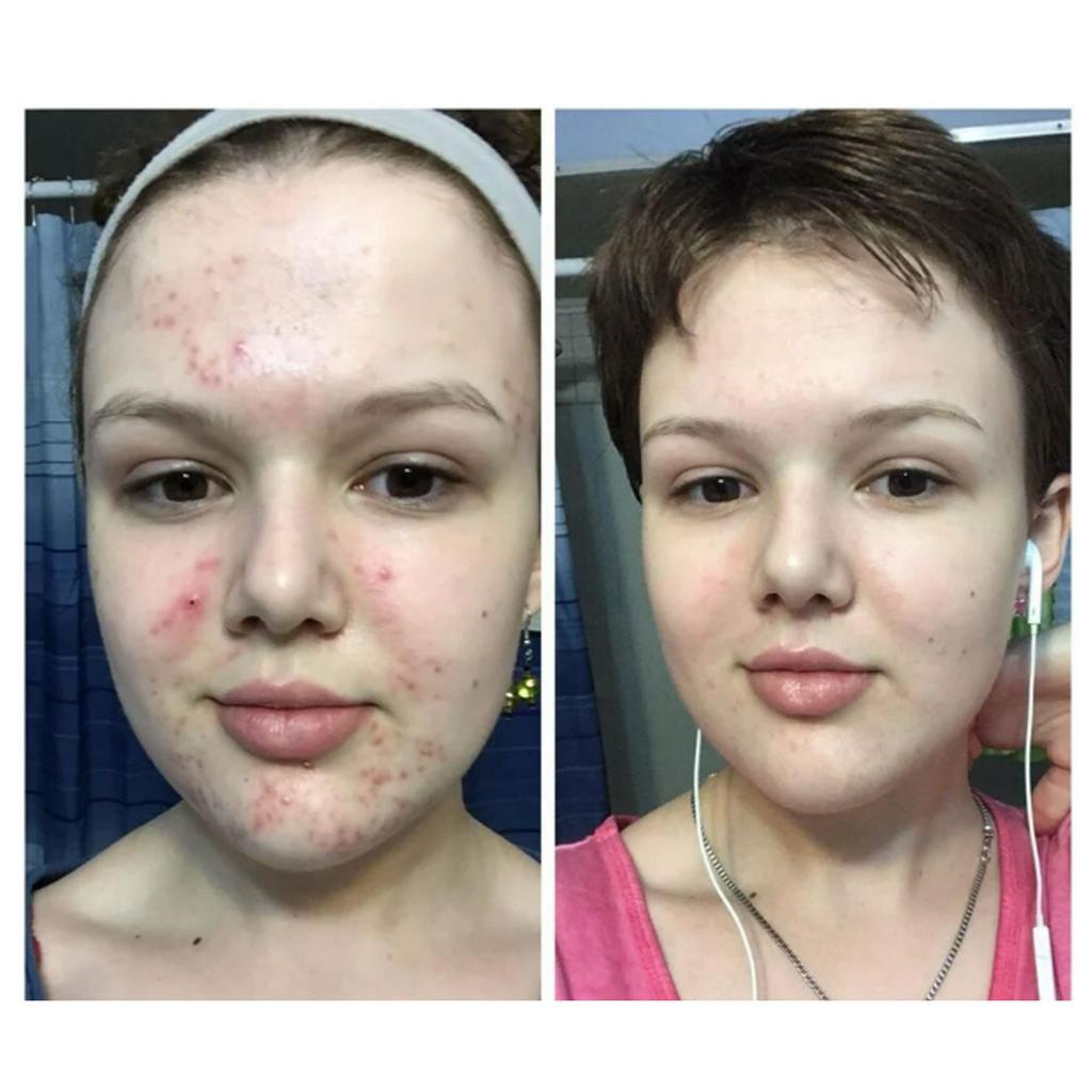 Gel chấm mụn Benzac AC 5% (Benzoyl peroxide 5%) Chính Hãng