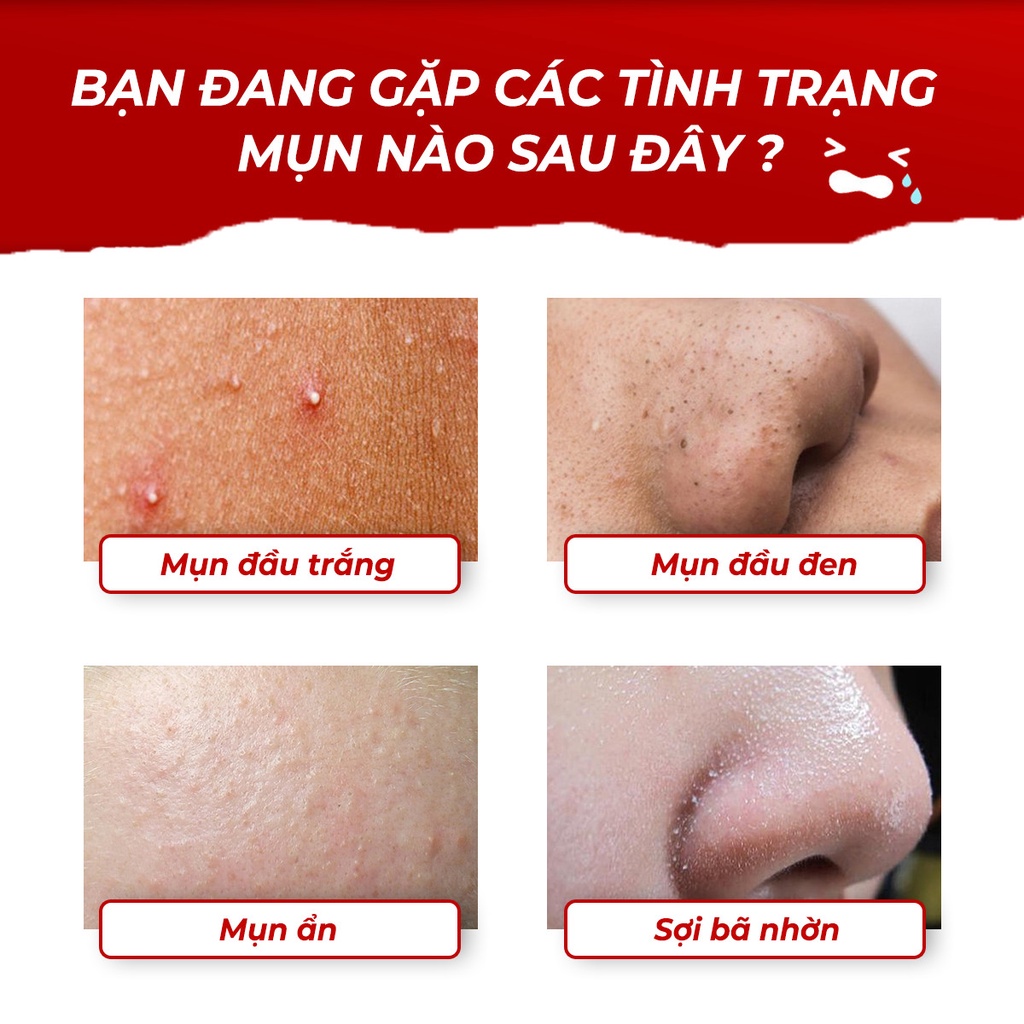 Serum Giảm Mụn Oriskin GenZ White Acne Serum Loại Bỏ Các Loại Mụn Viêm, Trứng Cá Và Mụn Đầu Đen 30ml