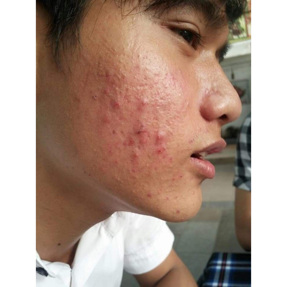 Cao mụn đông y Acnes Skin Care Almonds | BigBuy360 - bigbuy360.vn