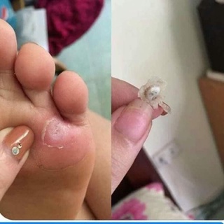 [HÀNG THÁI] KEM CHẤM MỤN CÓC,MUN RUOI, MUN THIT THÁI LAN