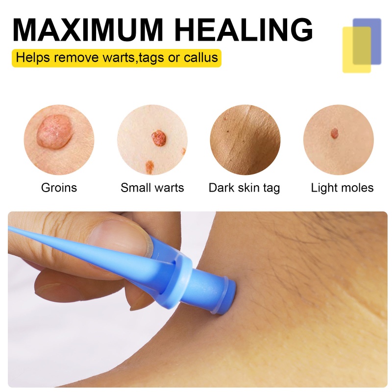 Youyo Bộ Dụng Cụ Loại Bỏ Mụn Cóc An Toàn Nhanh Chóng Trong Phút Và Khăn Lau