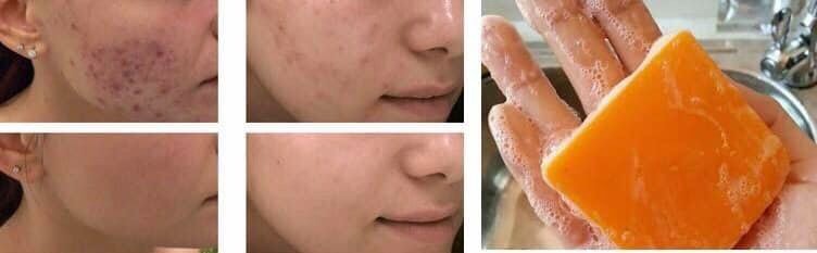 Soap Xà Phòng Cam Mụn Trứng Cá GALONG Herbal 60g - Thái Lan | BigBuy360 - bigbuy360.vn